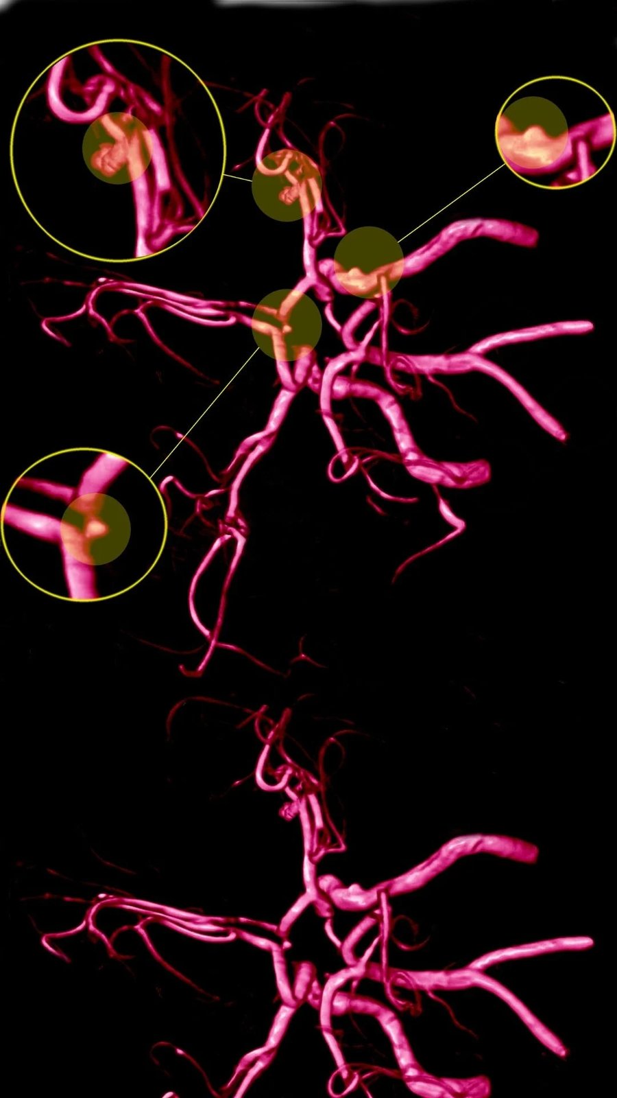 Reconstrução 3D de vasos cerebrais destacando pontos de aneurisma
