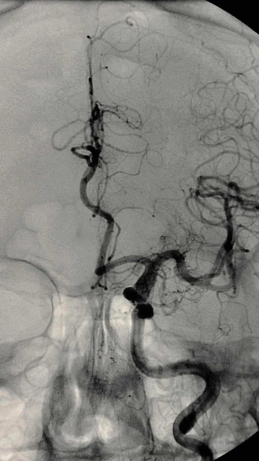 Angiografia por raio-x mostrando vasos cerebrais
